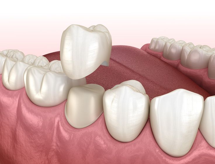 Dental Crowns & Bridges Banner